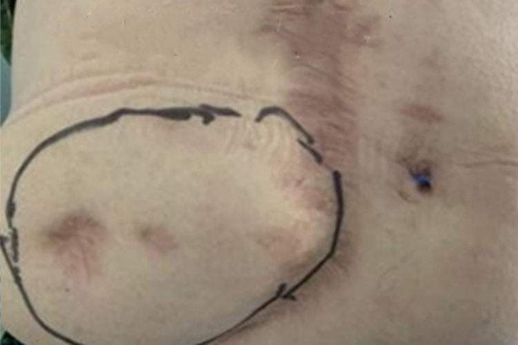 切口疝右腹包块图 切口疝右腹包块图