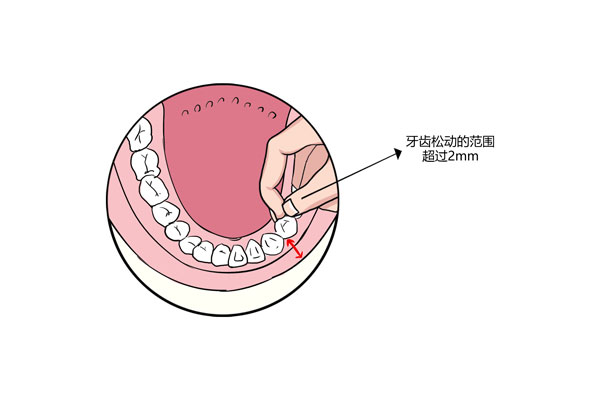 如何判断牙齿三度松动
