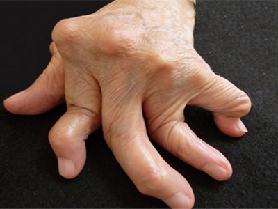 手指类风湿性关节炎手指变形明显图