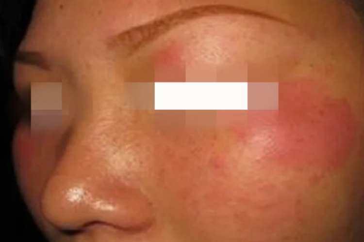 盘状红斑狼疮面部发红肿胀图 盘状红斑狼疮面部发红肿胀图