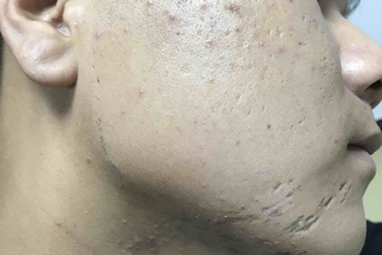 黑头粉刺样痣面部黑头粉刺图 黑头粉刺样痣面部黑头粉刺图