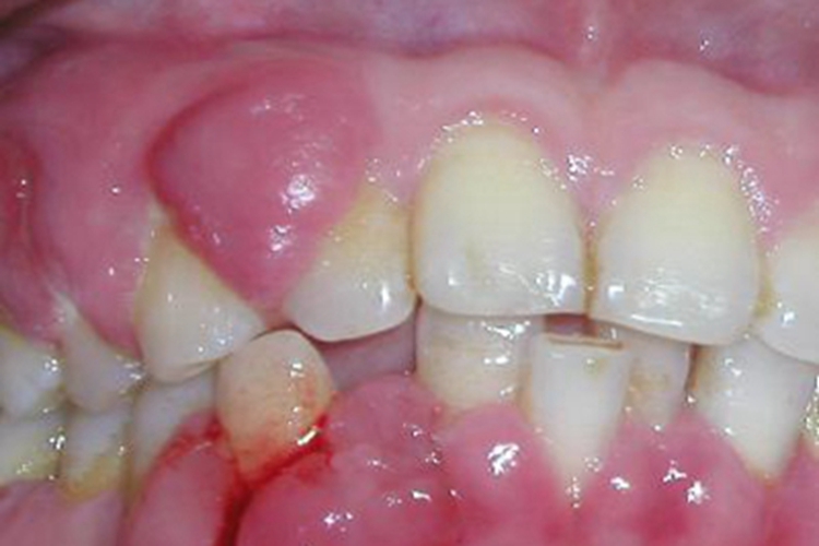 慢性龈炎牙龈上有肿块图