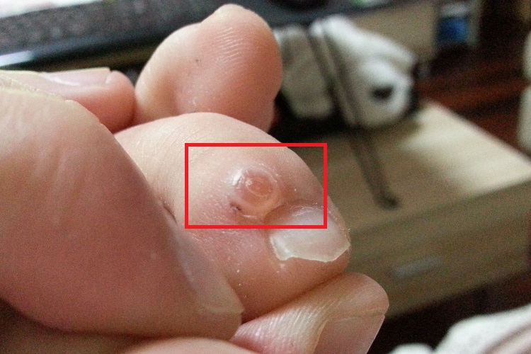 脚趾长水疱症状图