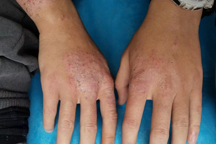 亚急性湿疹手背皮肤粗糙图