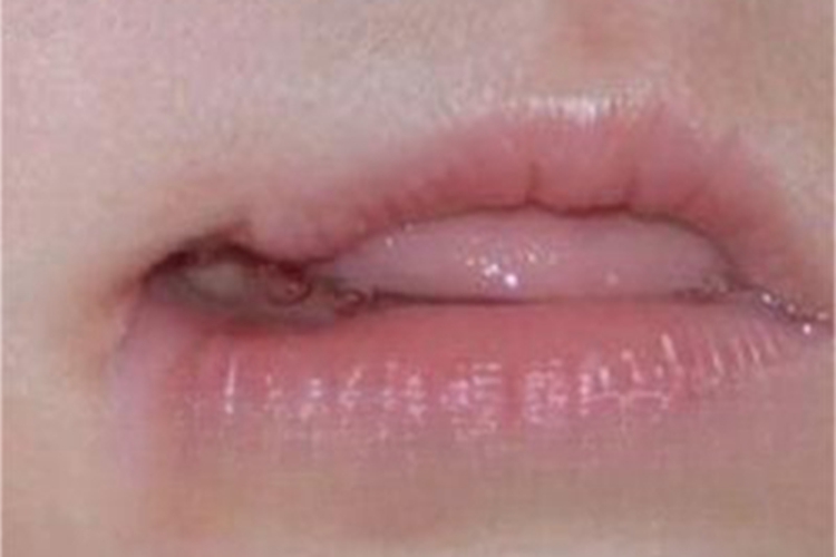 轻度大口畸形症状图