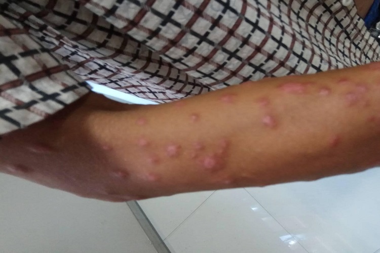 女性结节性梅毒疹丘疹图