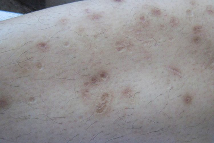 糖尿病胫前色素斑图