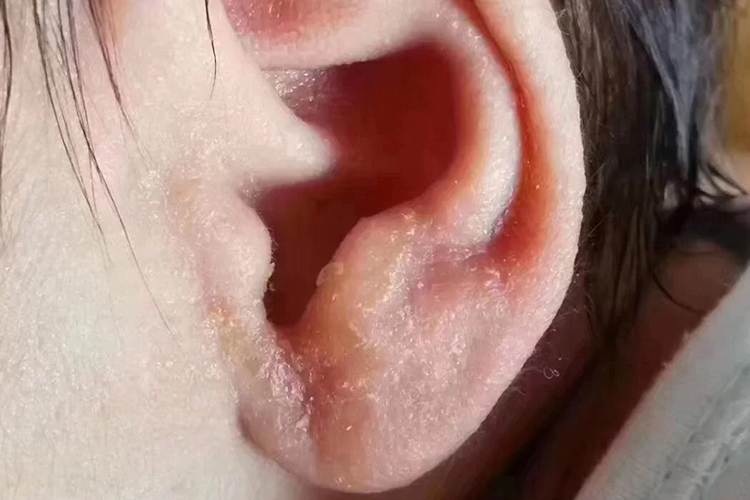 宝宝耳朵脱皮症状图片