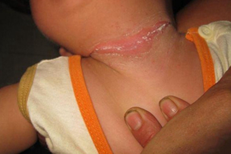 念珠菌性间擦疹前颈脱屑图