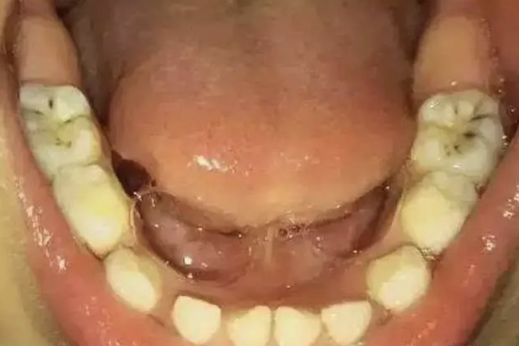 乳牙后牙浅龋图 乳牙后牙浅龋图