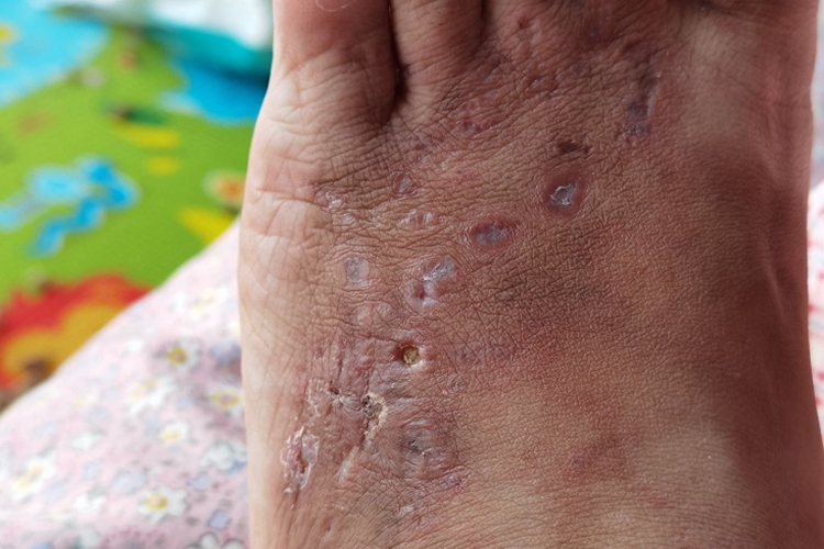 青斑性血管病皮肤糜烂图