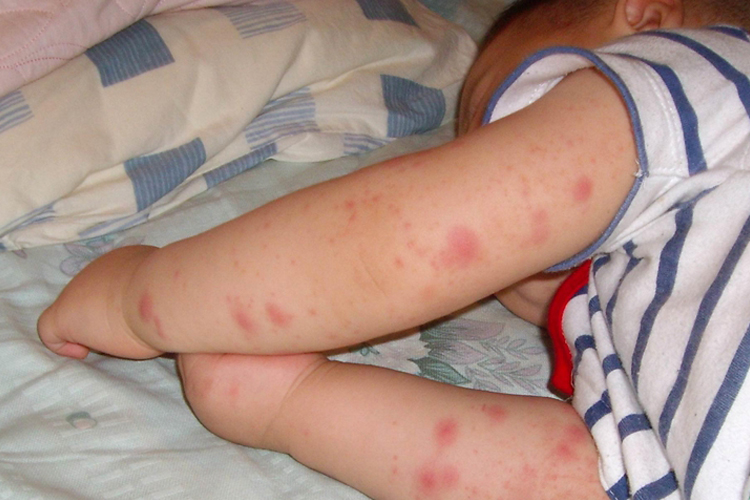 白血病非特异性皮损图 白血病非特异性皮损图