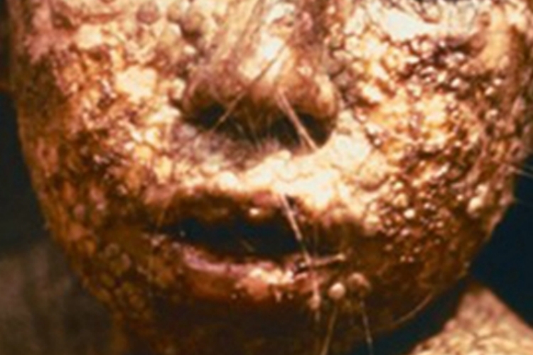 天花面部有密密麻麻的疙瘩图