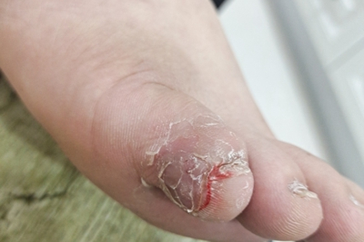 软鸡眼脚趾症状图 软鸡眼脚趾症状图