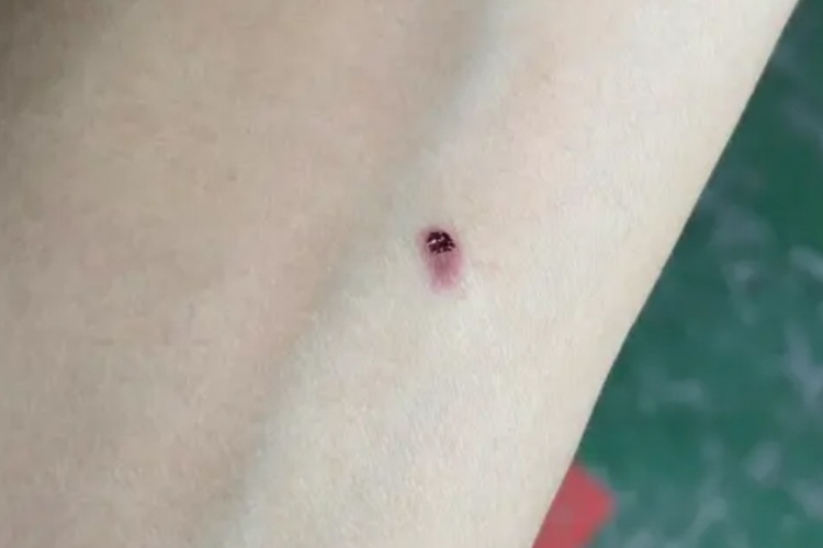 结核菌素试验阳性硬结图