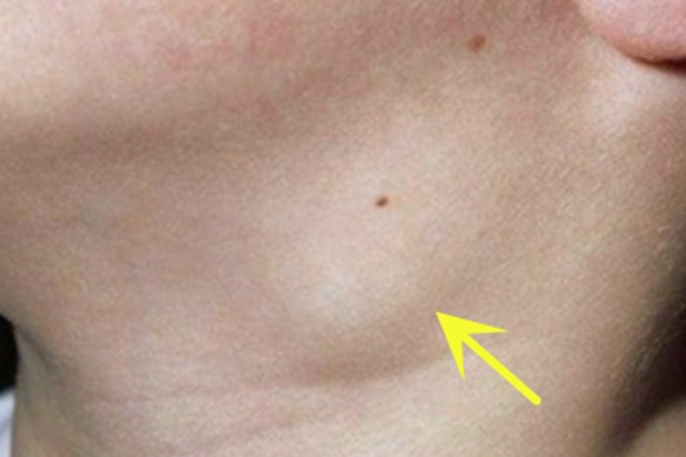 男性一期梅毒硬化性淋巴结炎图