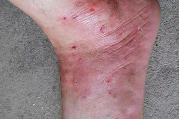 湿疹样型癣菌疹症状图