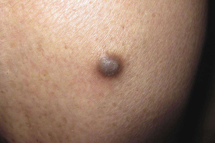 屁股长一个硬疙瘩图