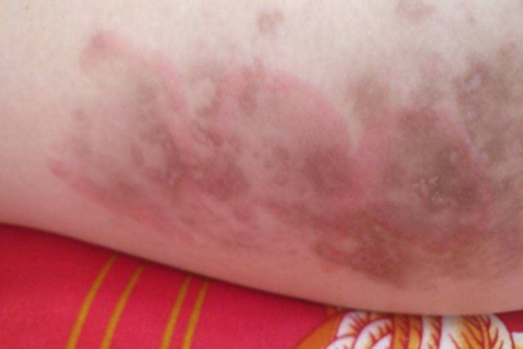 Ⅱ度冻伤症状图