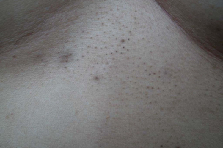 小棘毛壅病上腹症状图 小棘毛壅病上腹症状图