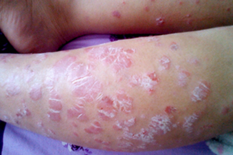 斑状淀粉样变小腿有红斑脱屑图 斑状淀粉样变小腿有红斑脱屑图