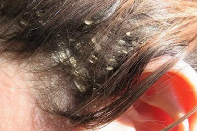 头皮糠疹头皮症状图