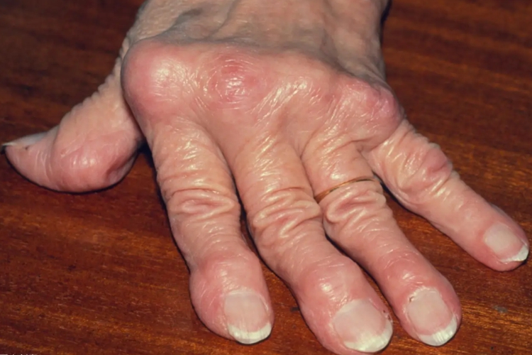 类风湿关节炎畸形手指图 类风湿关节炎畸形手指图