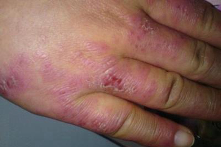 冻疮手部斑块糜烂图