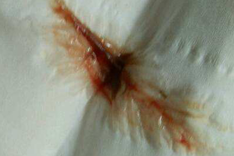 前置胎盘分泌物带血丝图