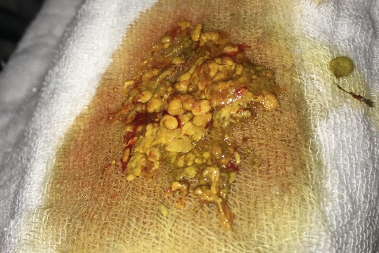 细菌性痢疾图 细菌性痢疾图