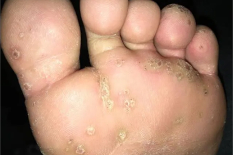 掌跖点状角化脚底脱屑图
