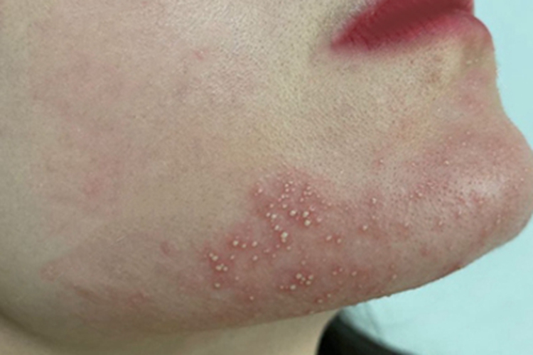 毛囊性脓疱病脓包图