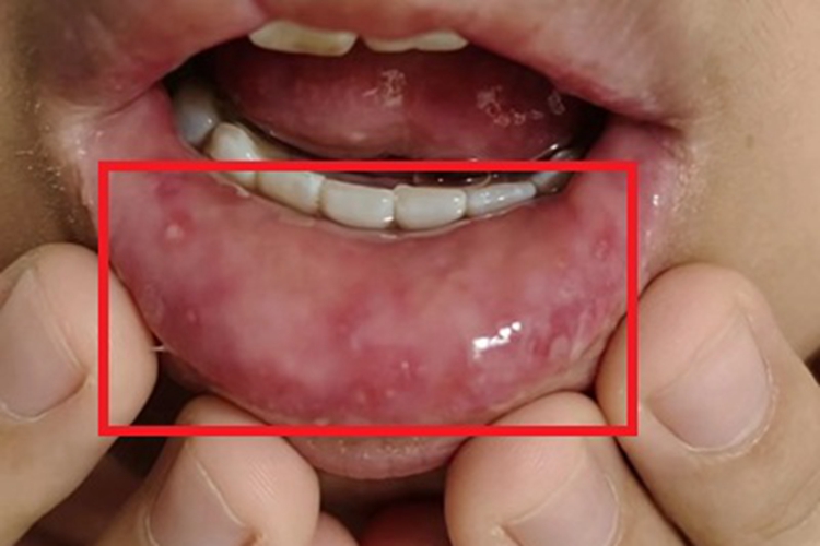 疱疹性口炎唇内侧水疱图