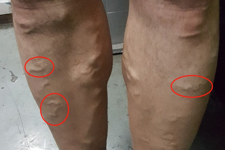 下肢静脉曲张小腿纹图