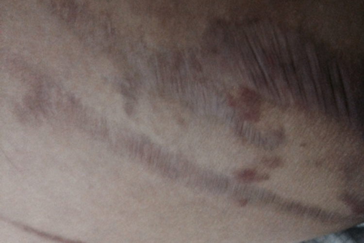 大腿内侧黑色条纹图