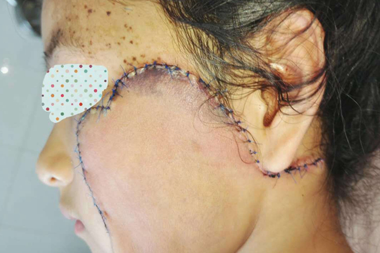 脸部植皮后恢复图