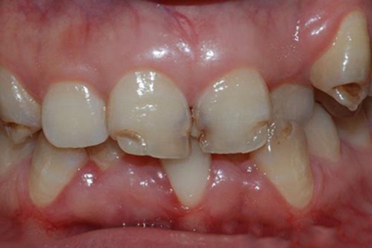 牙釉质发育不全牙齿坑图