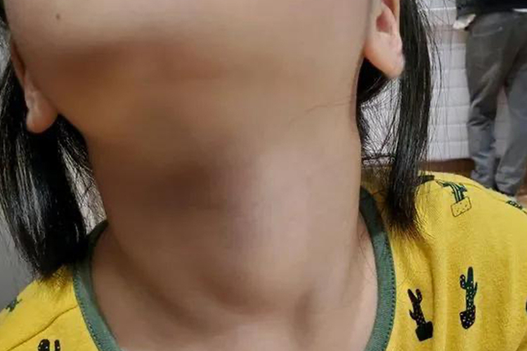 儿童碘缺乏症甲状腺肿大图