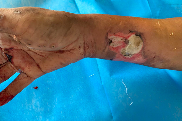 严重烧伤引起的焦黄创面图