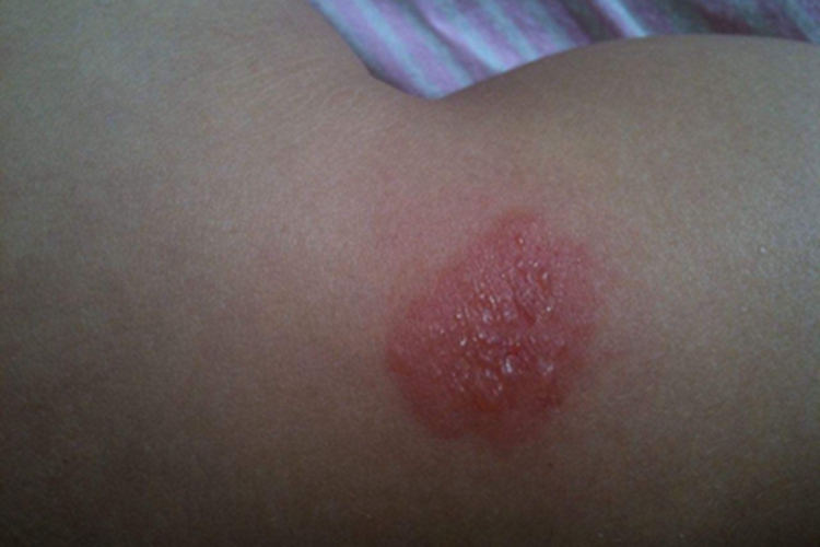 深脓疱疮小水疱图