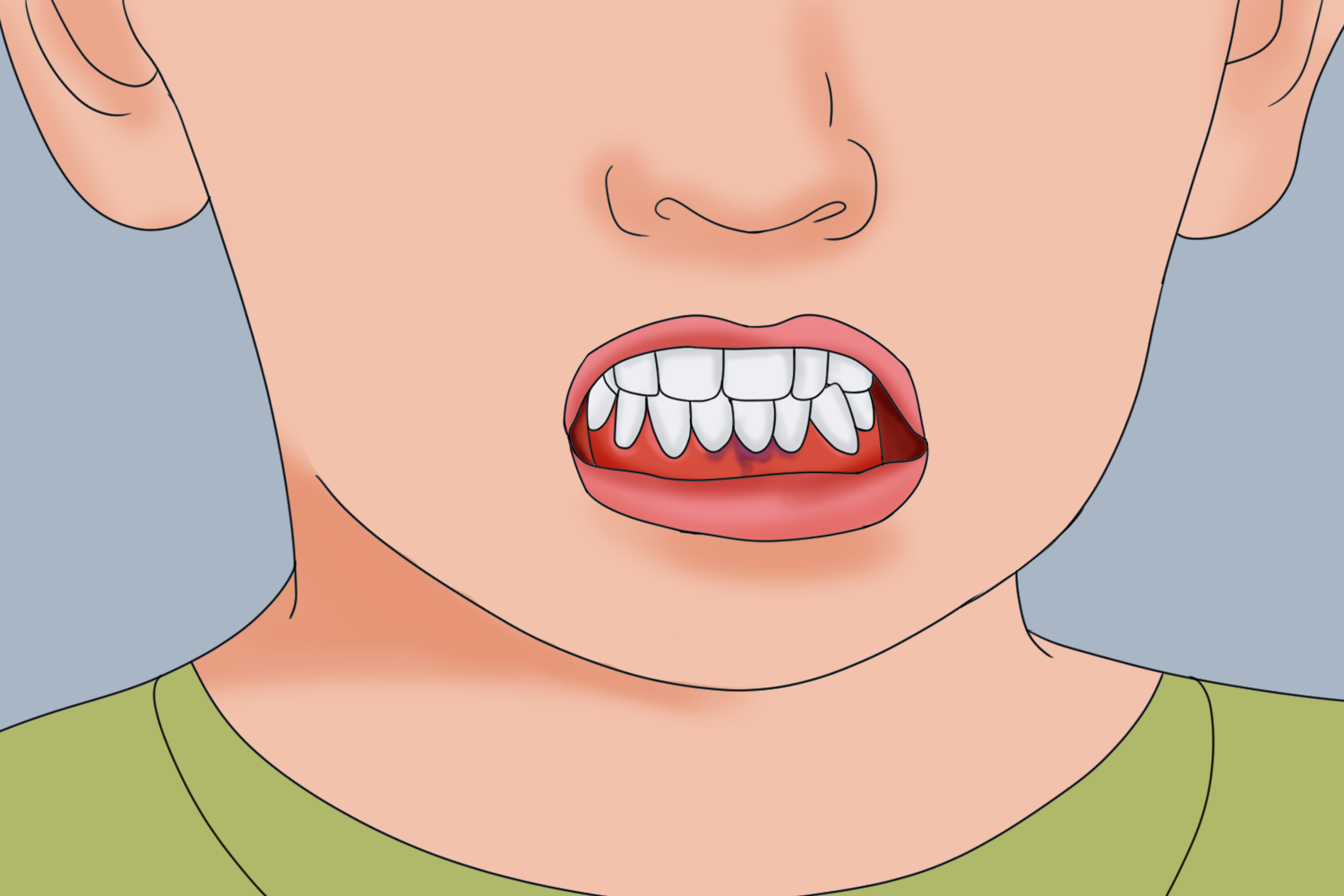 儿童铅中毒牙龈图