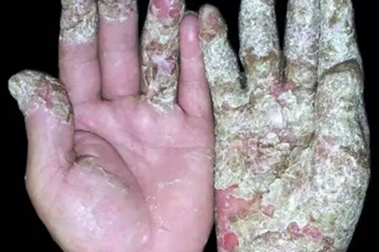 连续性肢端皮炎手指结痂图