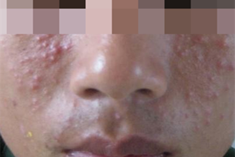 隐球菌病症状图