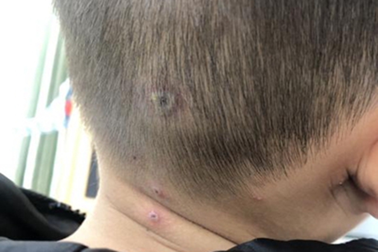 水痘头皮症状图