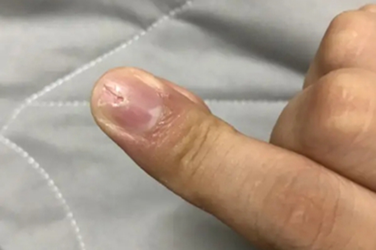 甲纵裂食指掉了一大块图