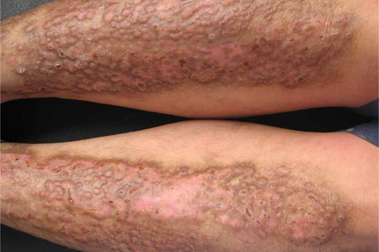 松皮癣小腿红斑图 松皮癣小腿红斑图