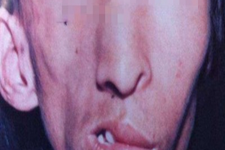 面部偏侧萎缩脸部变形图 面部偏侧萎缩脸部变形图