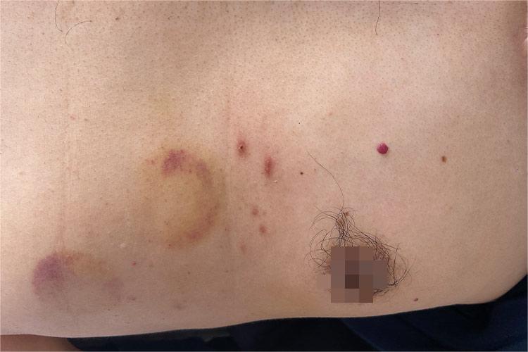 单个樱桃状血管瘤图