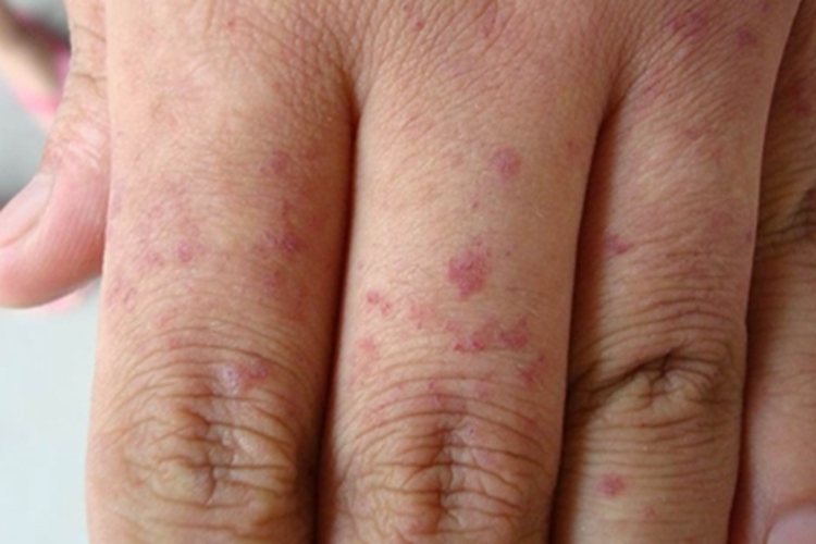 肢端型血管角皮瘤手背长红点图