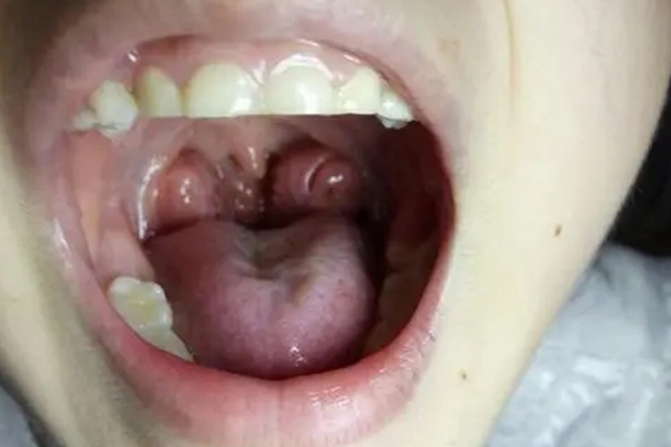 扁桃体炎腭舌弓发炎红肿图